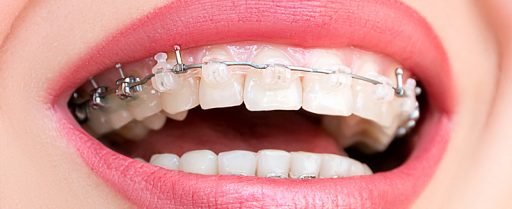 tratamiento-ortodoncia-estetica-3